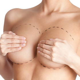 eine Brustvergrößerung in München mit Silikongelimplantaten