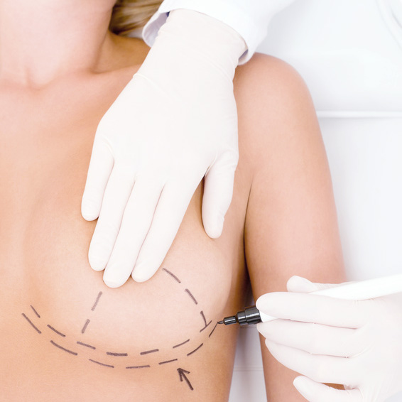 Brustvergrößerung mit Silikonimplantaten 