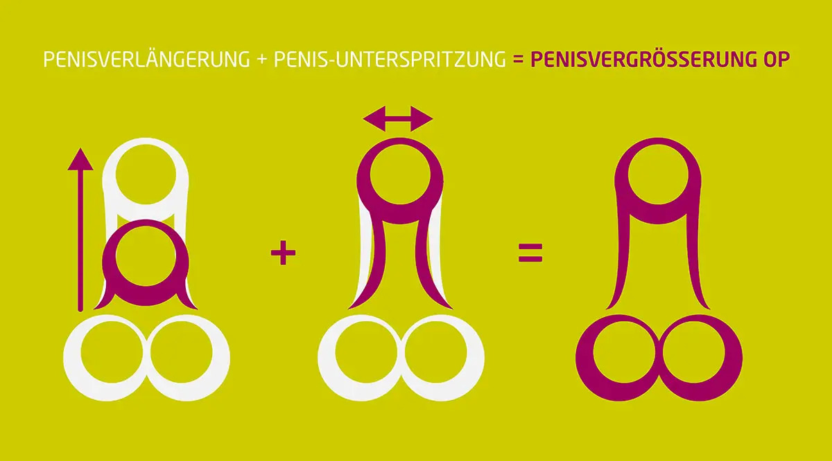 Penisvergrößerung OP Köln