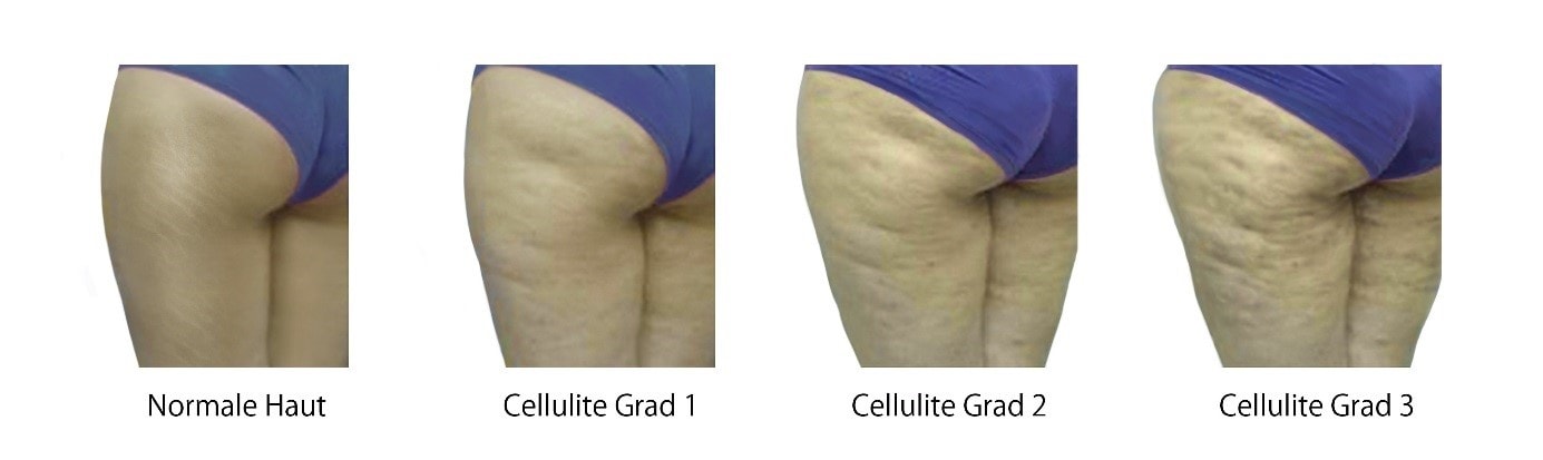 Cellulite Behandlung vorher